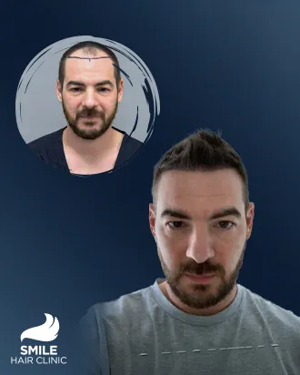 video Before - After 2