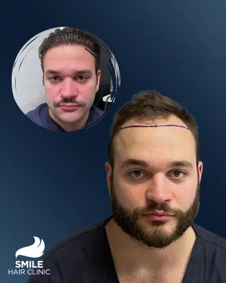 video Before - After 6